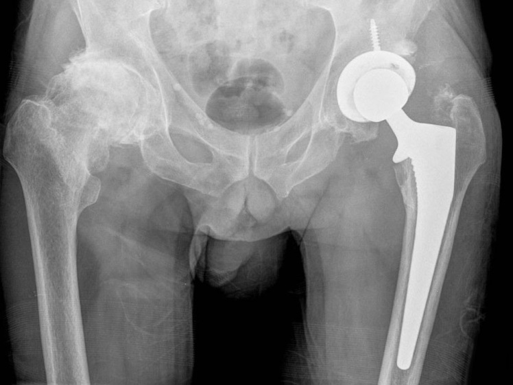 Hip Replacement