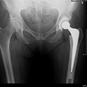 Hip Replacement