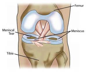 Meniscal-Repair