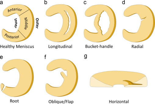 Meniscectomy