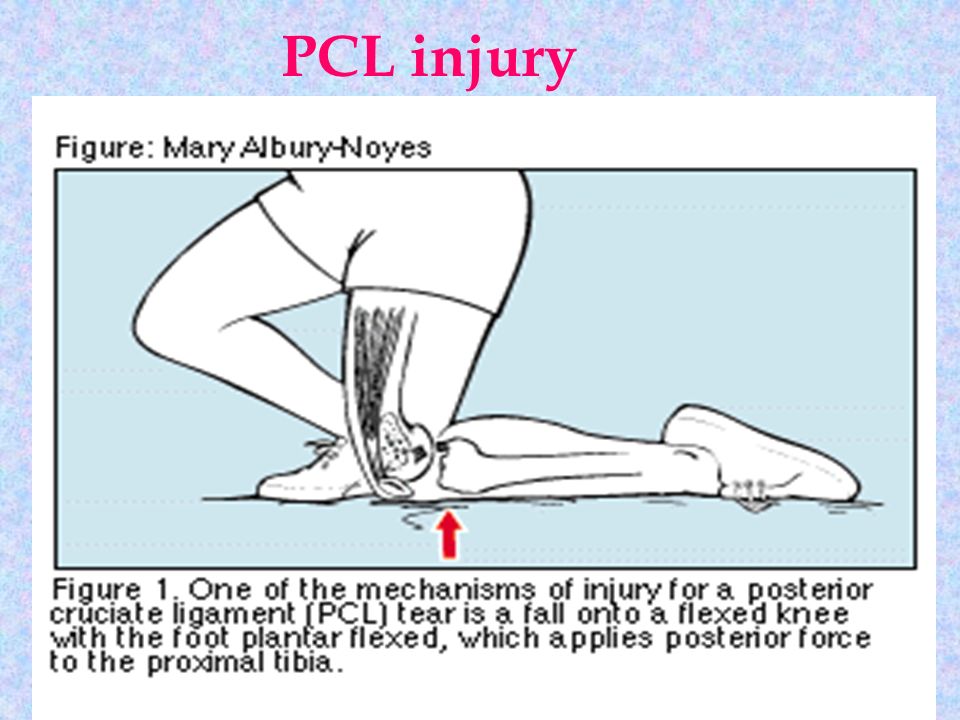 PCL
