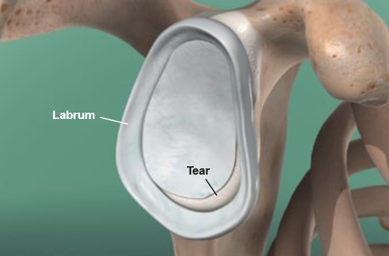 Shoulder Dislocation 