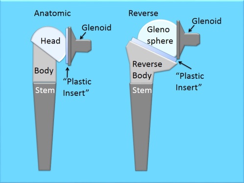 Shoulder-Replacement