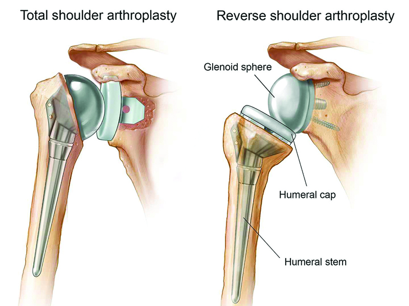 Shoulder-Replacement
