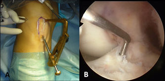 acl reconstruction