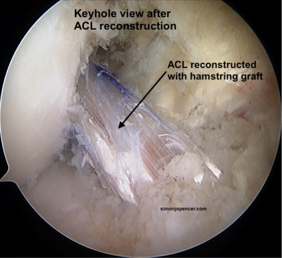 acl reconstruction