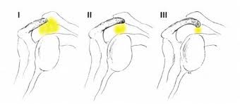 acromioplasty