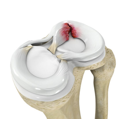 meniscal tear