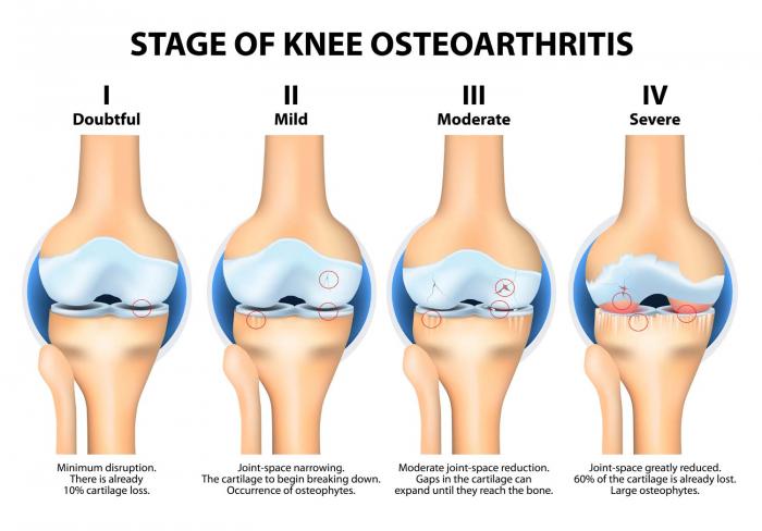 osteoarthritis.