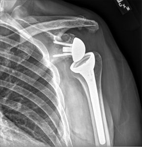 reverse-shoulder-replacement.jpg