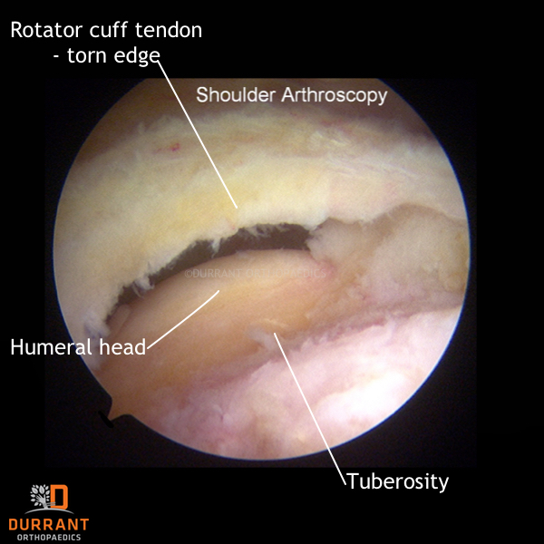 rotator cuff image