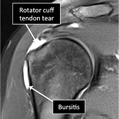 rotator cuff 