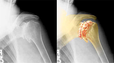 shoulder arthritis image 