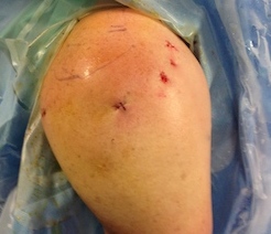 shoulder arthroscopy