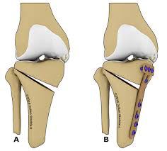 tibial osteotomy