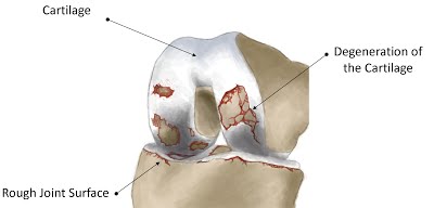 total knee replacement