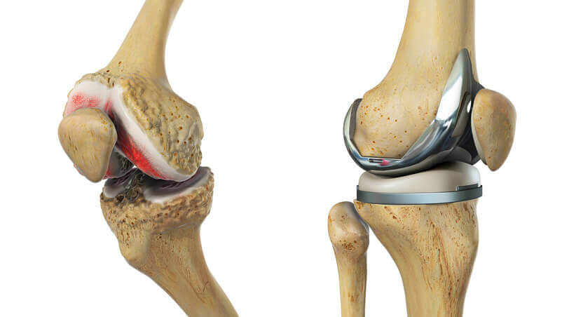 total knee replacement