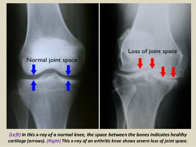 total knee replacement